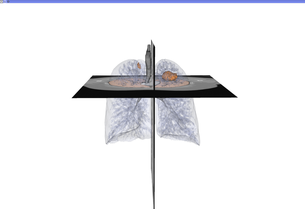 Tumour identification in the lungs using indirect volume rendering.