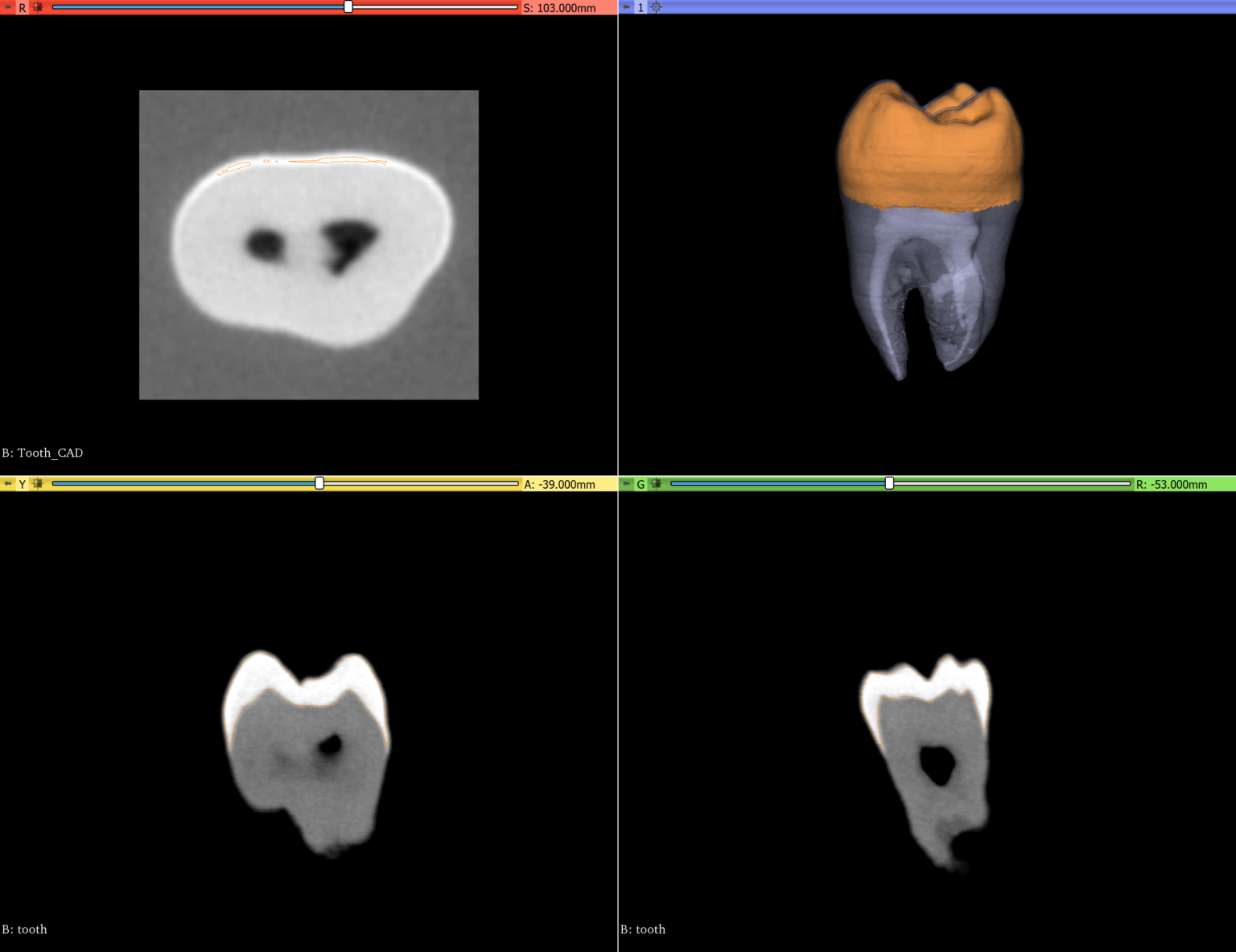 Indirect Volume Rendering of the tooth
