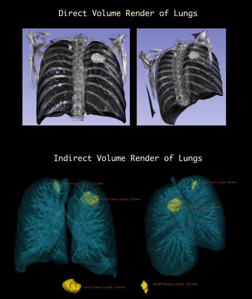 Direct and Indirect volume render of lungs with tumours (2).